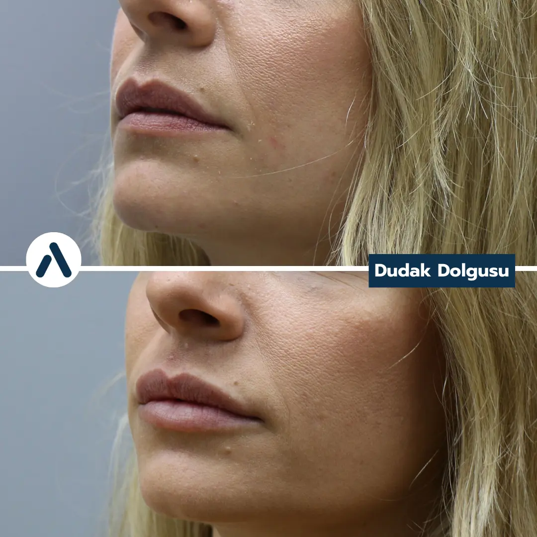 dudak-dolgusu-oncesi-sonrasi-1