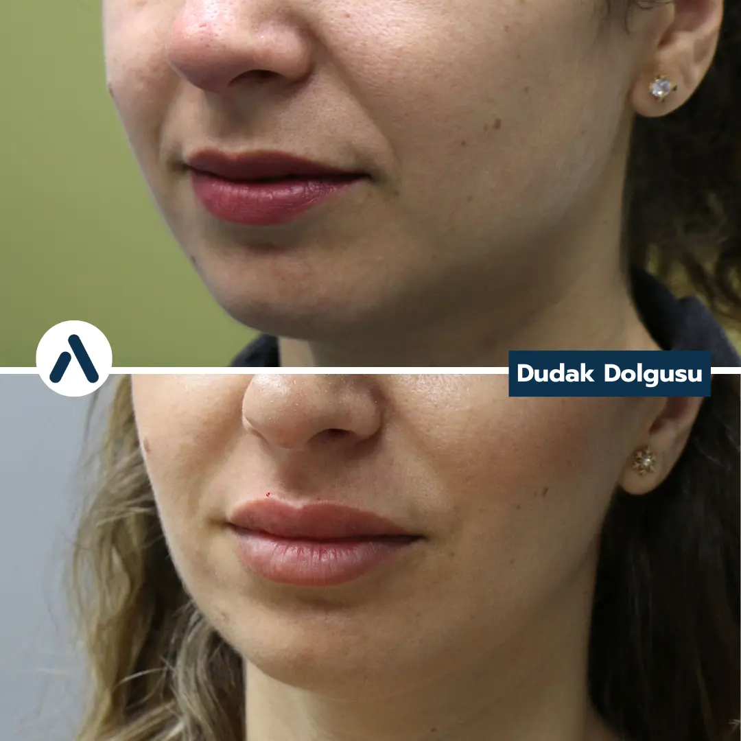 dudak-dolgusu-oncesi-sonrasi-11
