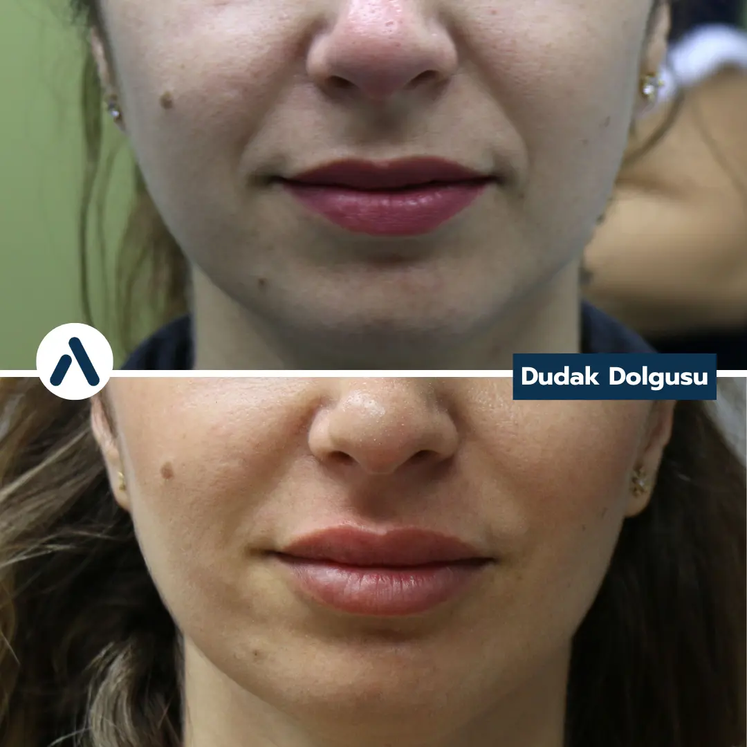 dudak-dolgusu-oncesi-sonrasi-13