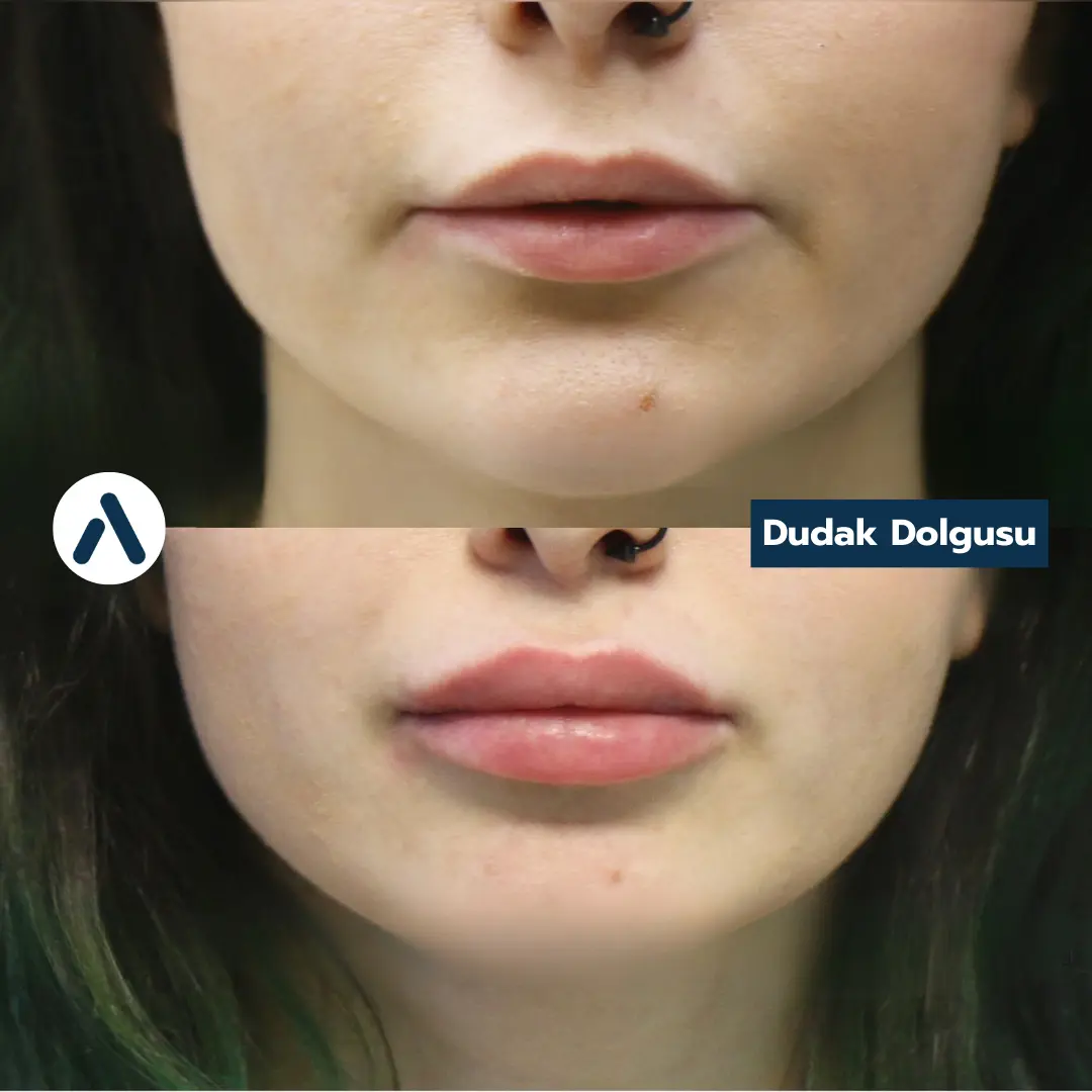 dudak-dolgusu-oncesi-sonrasi-14
