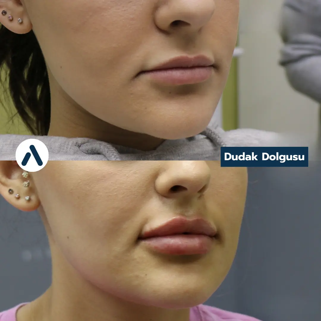 dudak-dolgusu-oncesi-sonrasi-2