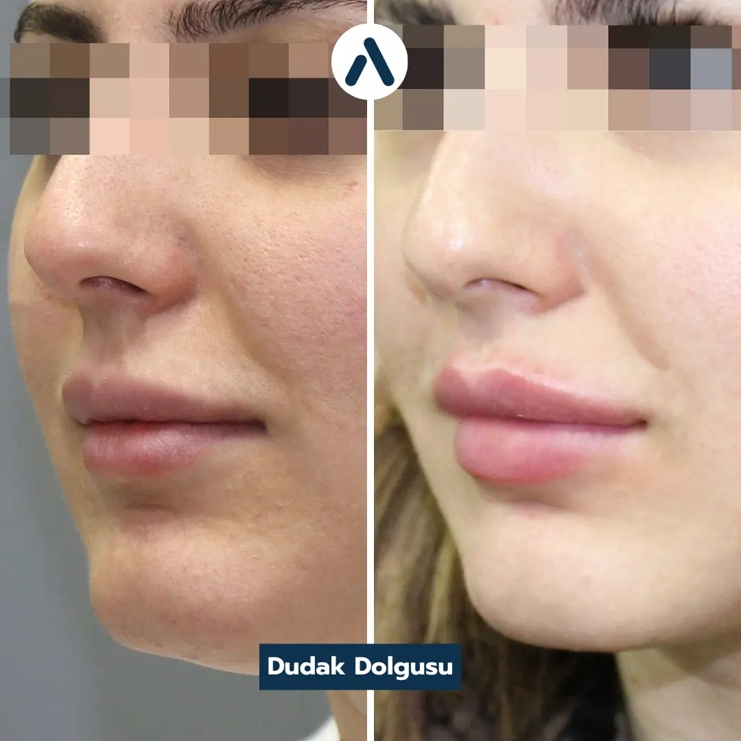 dudak-dolgusu-oncesi-sonrasi-3
