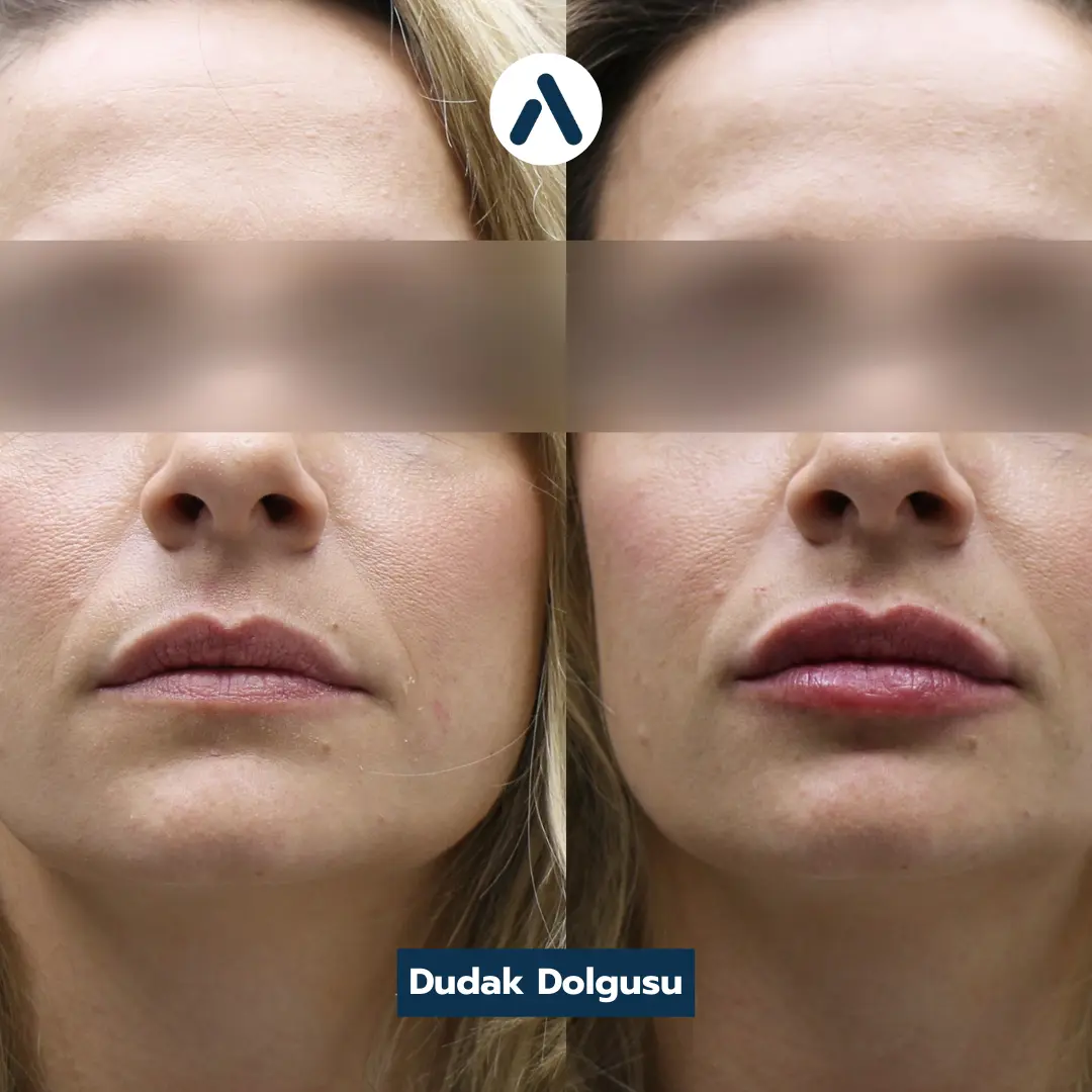 dudak-dolgusu-oncesi-sonrasi-4