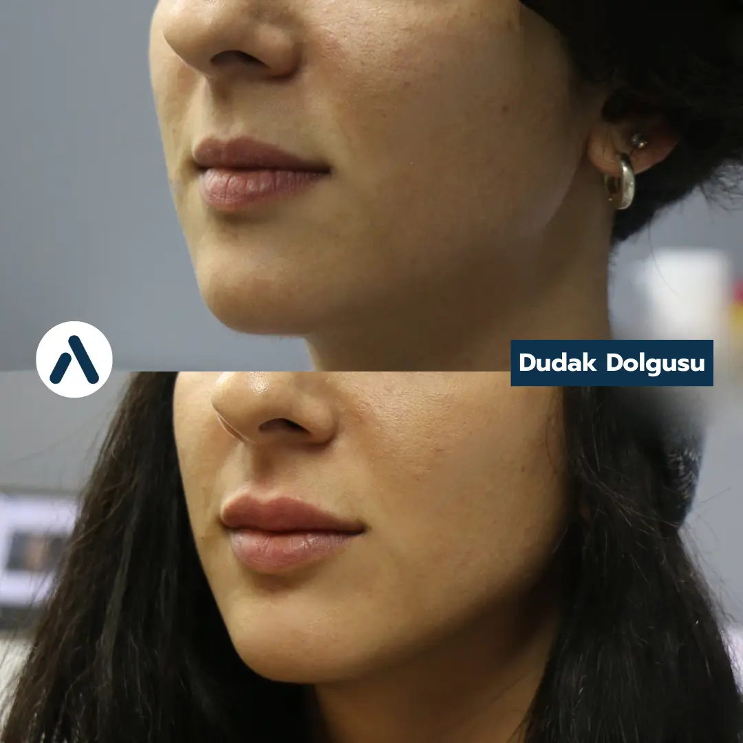 dudak-dolgusu-oncesi-sonrasi-6