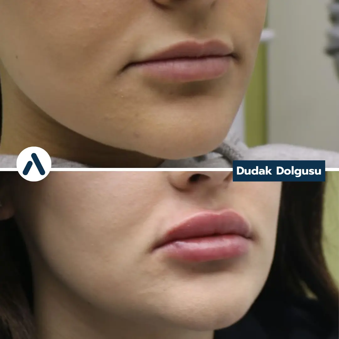 dudak-dolgusu-oncesi-sonrasi-7