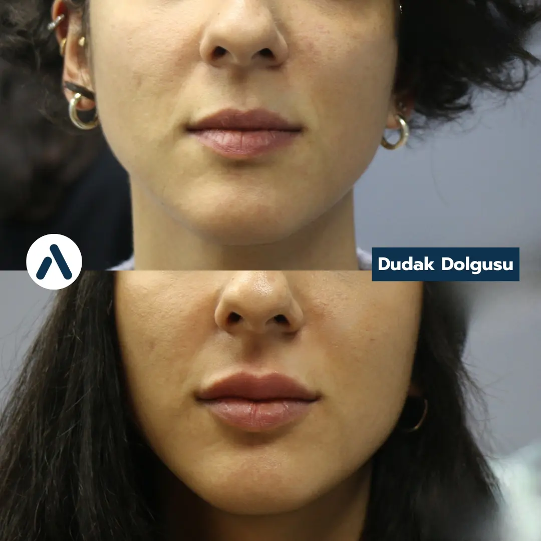 dudak-dolgusu-oncesi-sonrasi-8