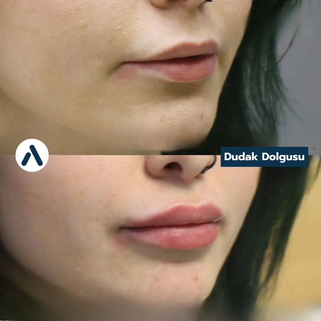 dudak-dolgusu-oncesi-sonrasi-9